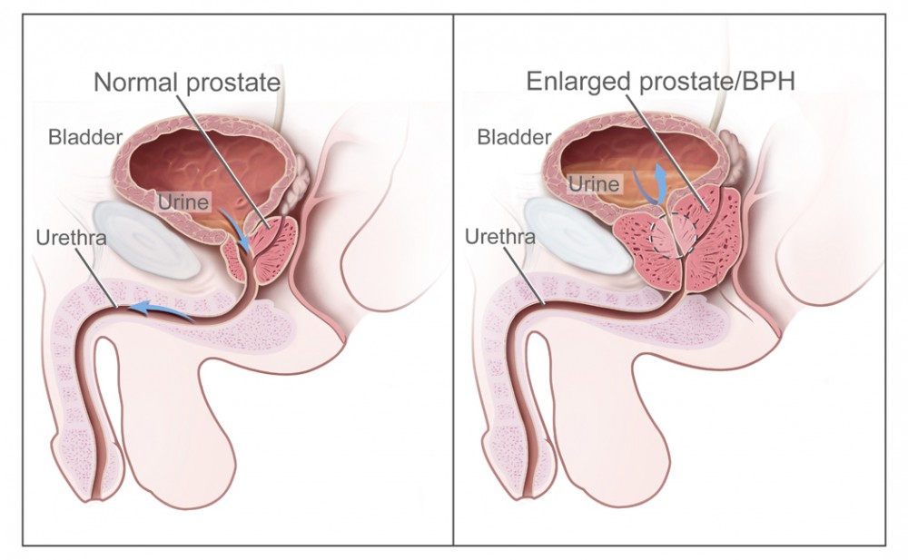 Benigne Prostatahyperplasie – Symptome und Behandlung