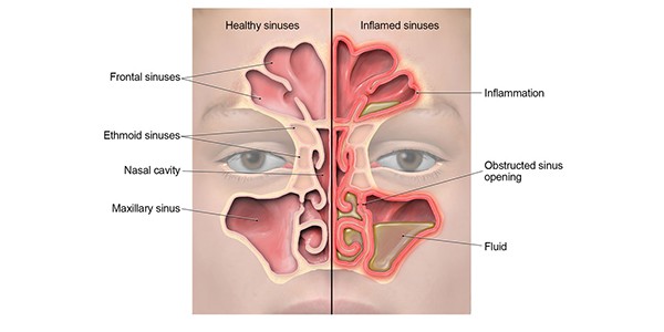 Sinusitis – Symptome und Behandlung