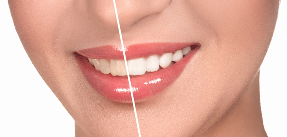 Dental Veneers