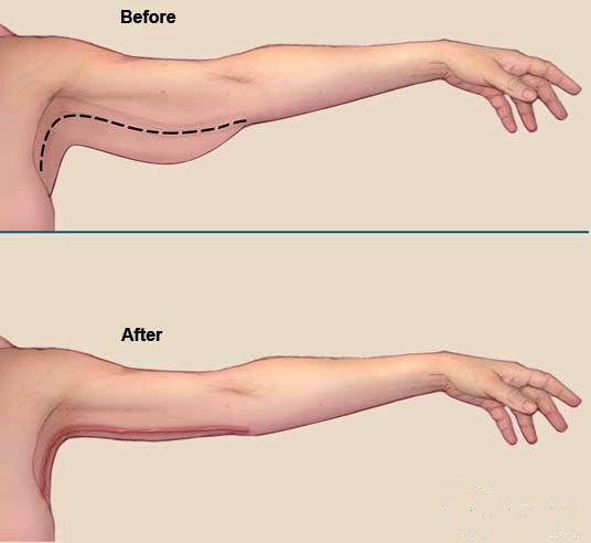Arm Lift Surgery in Turkey