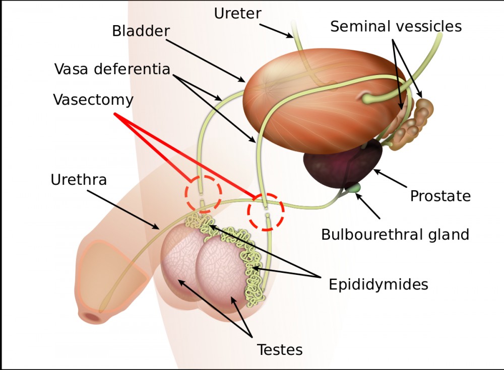 Vasectomy - Treatment & Information | Maximed Turkey