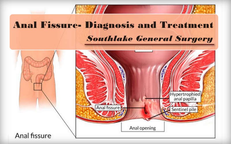 Anal Fissure - Symptoms, Diagnosis, Causes and Treatment