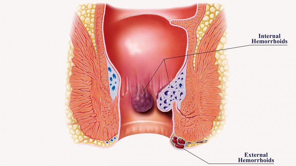 Hemorrhoids - Symptoms, Causes and Treatments
