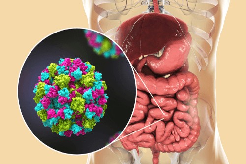 فهم التهاب المعدة والأمعاء الفيروسي