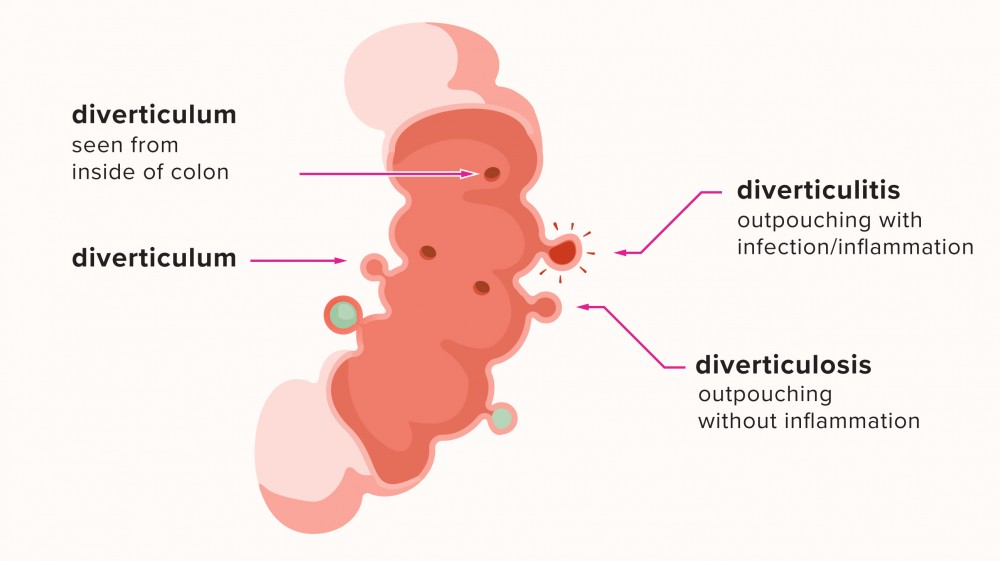 Diverticular Disease - Symptoms and Prevention 