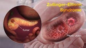 Syndrome of Zollinger-Ellison