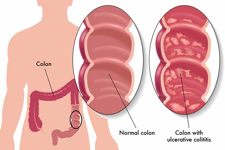 Ulcerative Colitis - Symptoms, Cure, and More