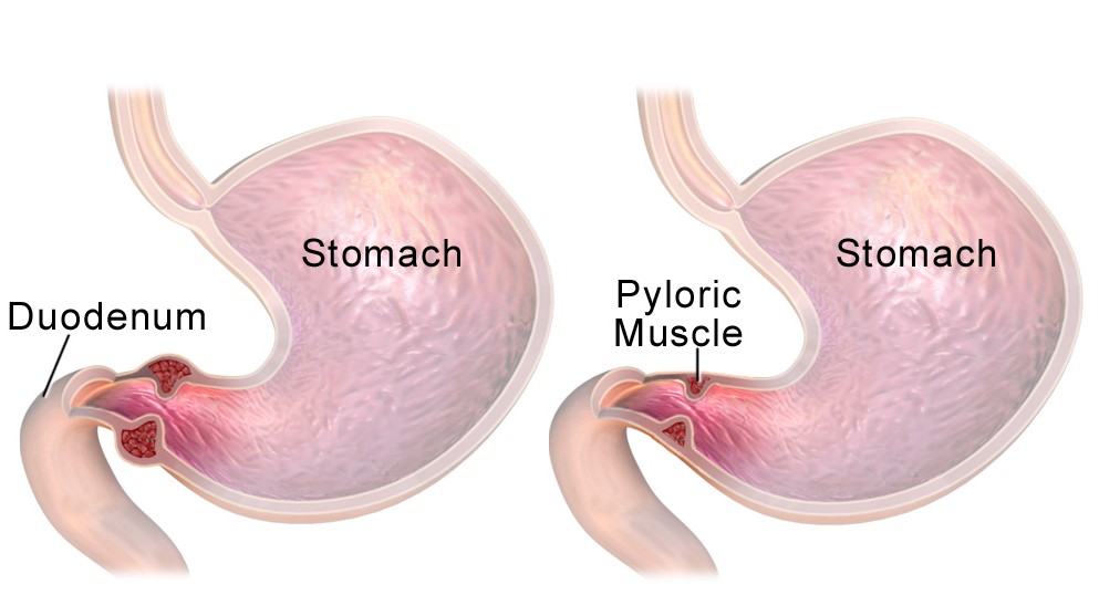 Pyloric Stenosis - Symptoms and Causes 