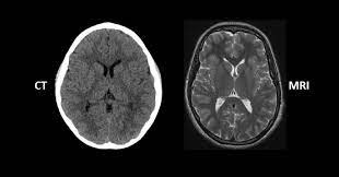 CT Scan vs. MRI: What's the Difference?