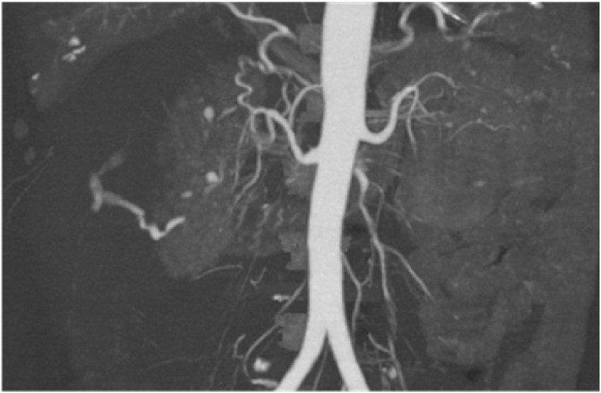 Abdominal Angiogram - Maximed Turkey Health Services