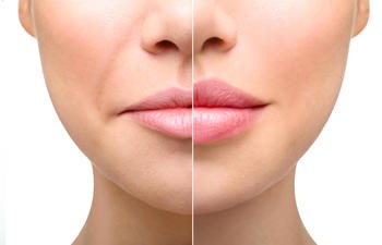 All about Lip Augmentation