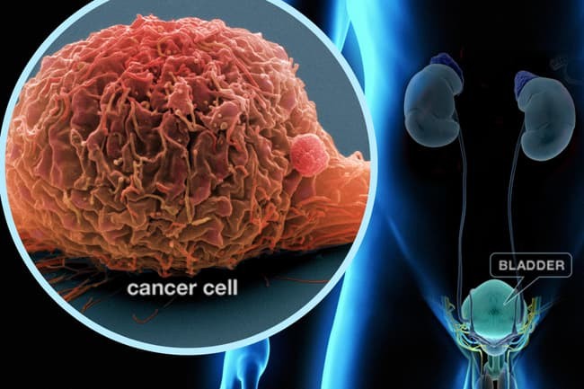 سرطان المثانة - ما تحتاج إلى معرفته