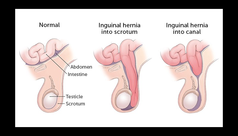 Hernia - Symptoms, Causes, Types and Treatment