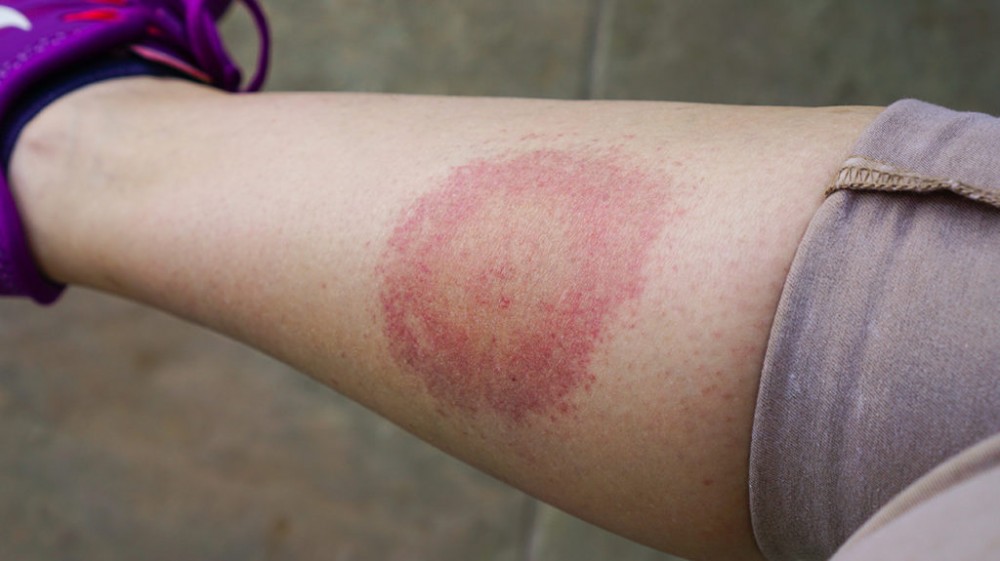 Lyme Disease - Symptoms and Causes - Maximed Turkey