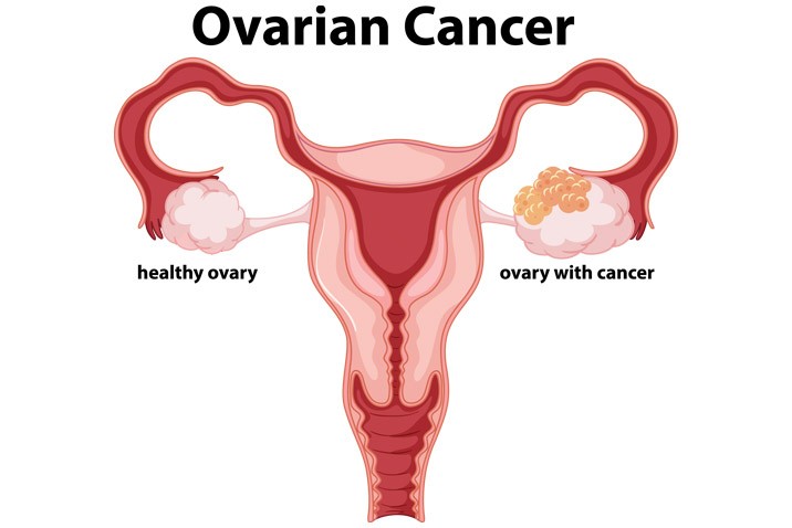 Ovarian Cancer - Symptoms, Prevention, Causes and Treatment - Maximed Turkey