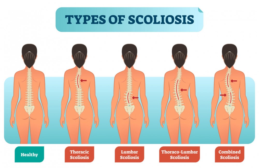 Scoliosis - Types, Symptoms and Treatment - Maximed Turkey