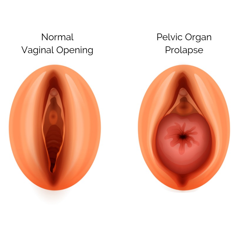 Vaginal Prolapse: Symptoms, Causes, Treatments - Maximed Turkey
