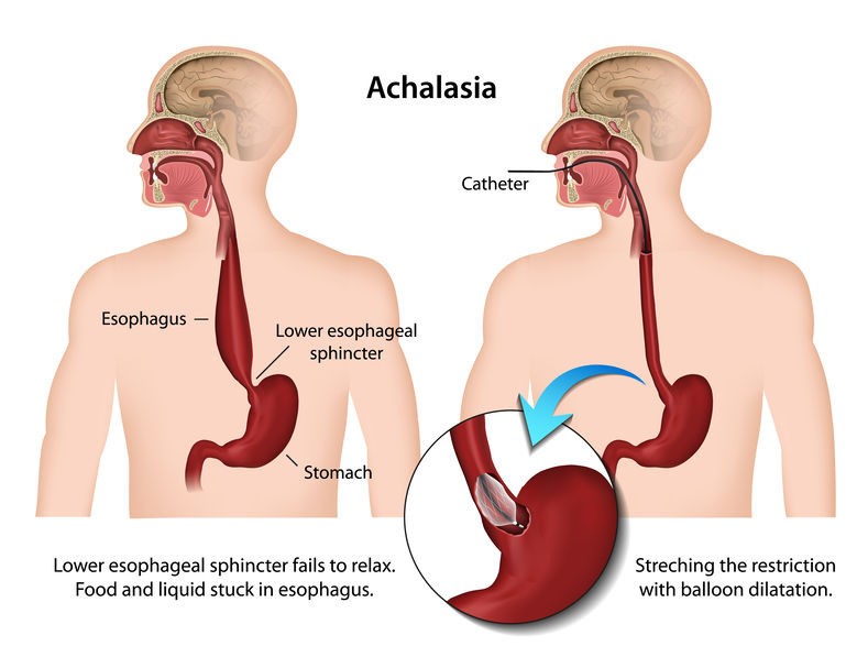 Achalasia (Esophagus Disorder) - Maximed Turkey