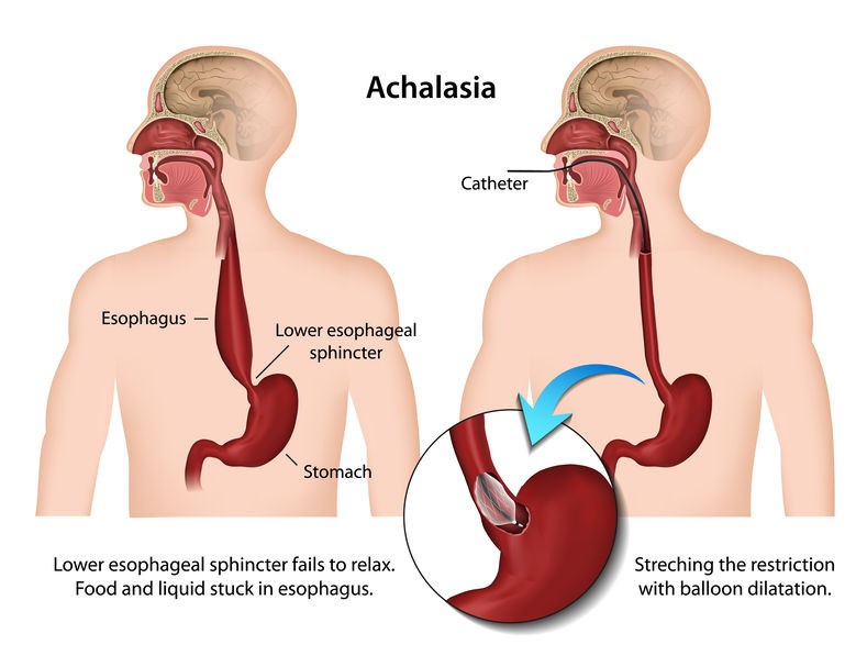 Achalasia (اضطراب المريء) - ماكسيميد تركيا