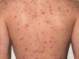 Chickenpox - Causes, Risk, Prevention and Treatment