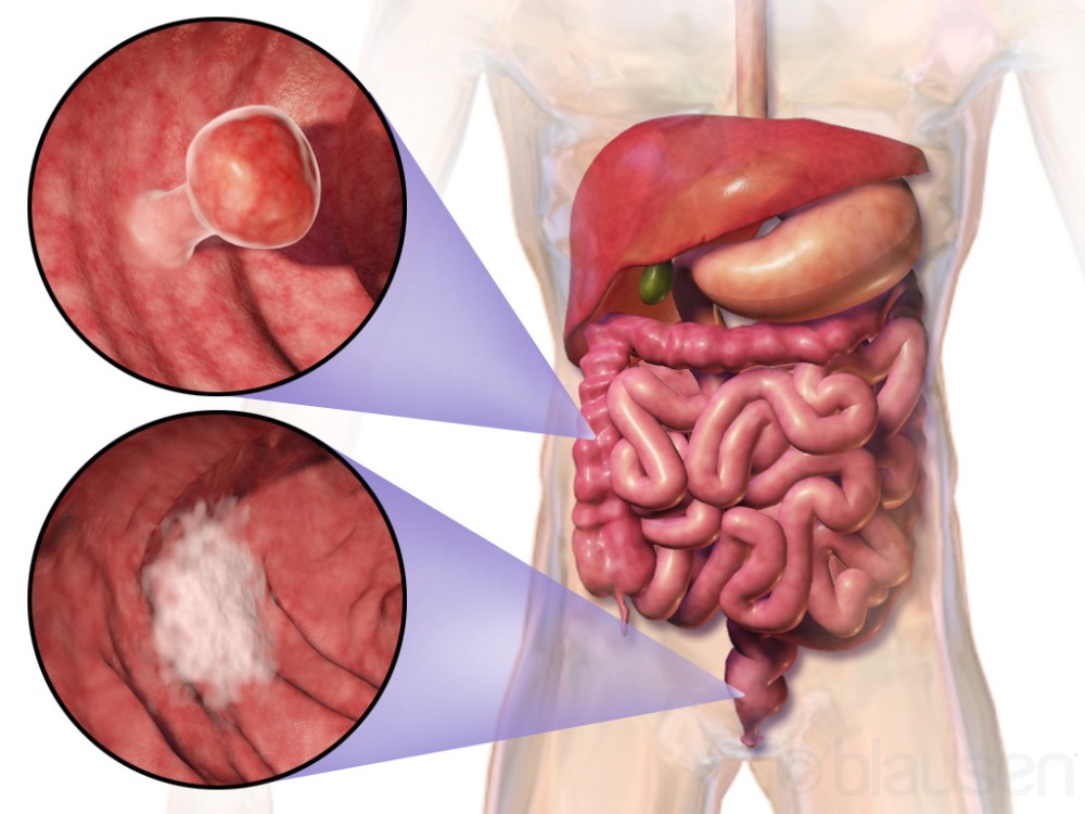 Colorectal Cancer - Symptoms, Treatments and Prevention