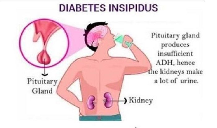 Несахарный диабет - симптомы, причины, диагностика, профилактика и лечение