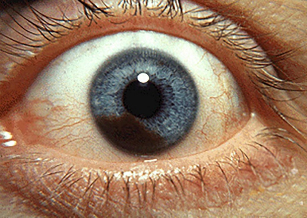 سرطان العين: الميلانوما داخل العين - مكسيميد تركيا
