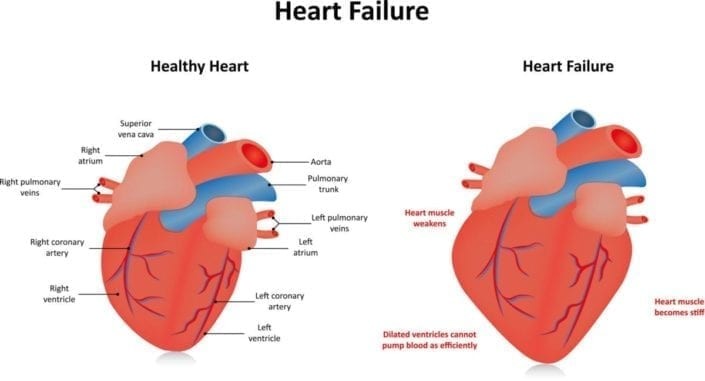 قصور القلب - الأعراض والتشخيص والعلاج