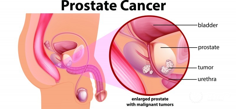 Prostate Cancer - Symptoms, Causes and Treatment - Maximed Turkey