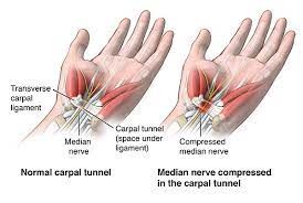 Karpaltunnel-Release-Chirurgie - Maximed Turkey