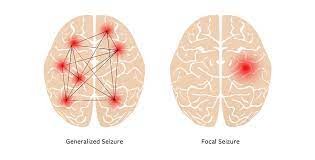 Focal Seizures - Maximed Turkey