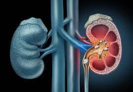 Kidney Stones - Diagnosis and Treatment