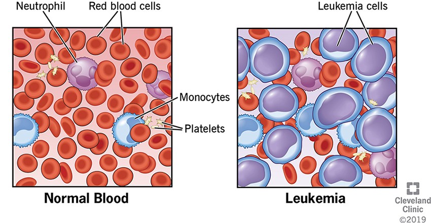 Leukemia - Symptoms, Prevention, Diagnosis and Treatment