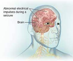 Рефрактерная эпилепсия - Максимед Турция