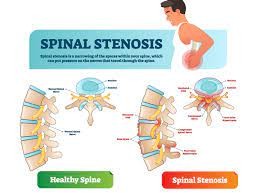 Spinal Stenosis - Symptoms, Risks and Treatment