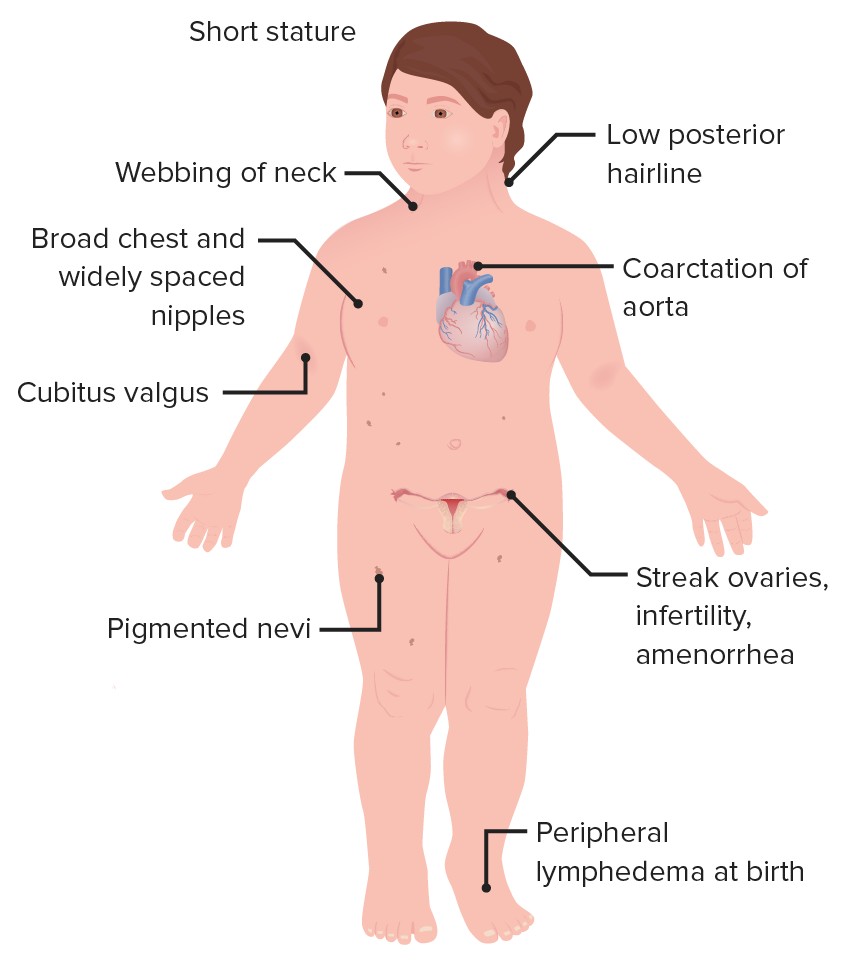 Turner Syndrome - Causes, Symptoms and Treatment