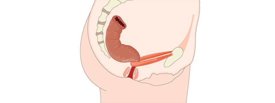 Bowel Dysfunction - Maximed Turkey