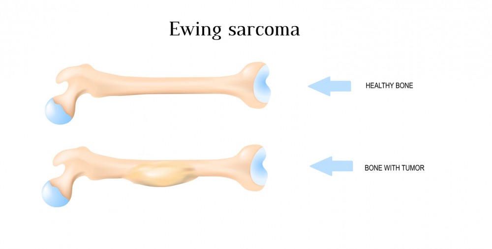 Саркома Юинга - симптомы, диагностика и лечение