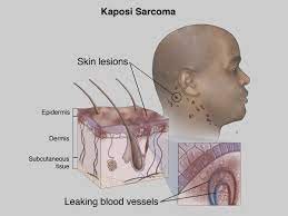 Саркома Капоши - причина, диагностика и лечение