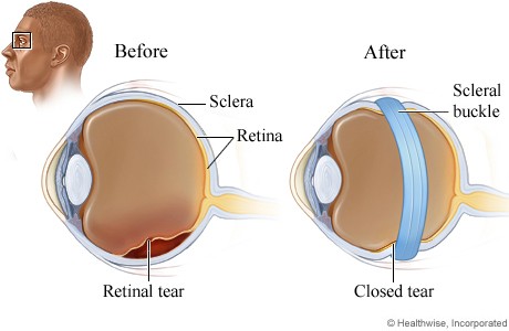 Scleral Buckling Treatment 