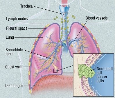 Adenocarcinoma Cancer: Symptoms, Causes, Diagnosis and Treatment