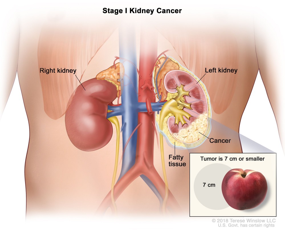Kidney Cancer - Causes, Symptoms and Treatment