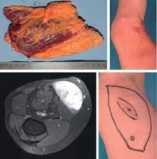 Liposarcoma - Maximed Turkey