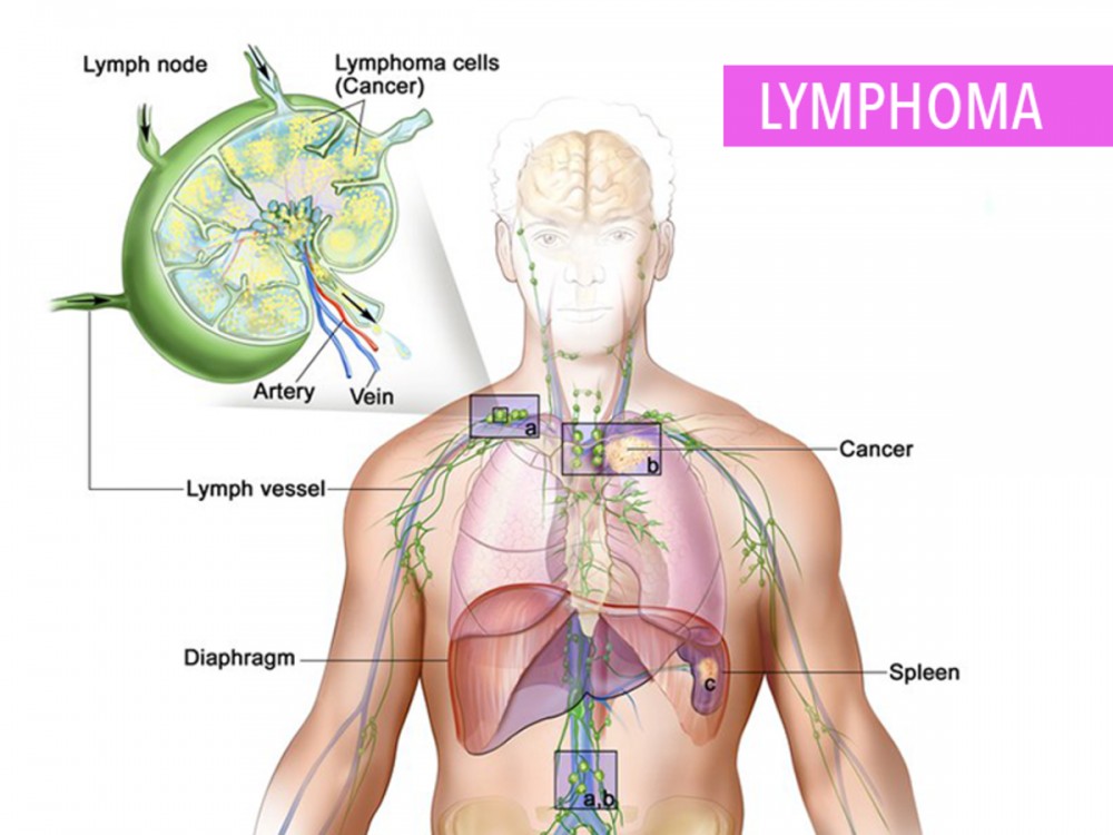 Лимфома - симптомы, причины и лечение