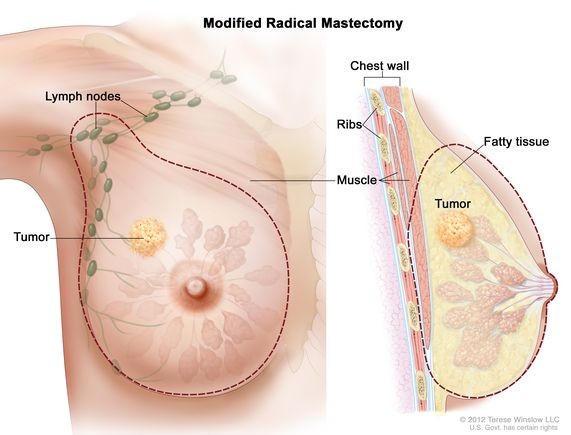 Mastectomy - Maximed Turkey