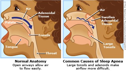 Obstructive Sleep Apnea In Children - Maximed Turkey