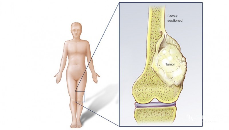 Osteosarcoma - Maximed Turkey