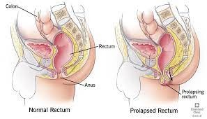 Rectal Prolapse - Treatment, Diagnosis, Causes & Symptoms