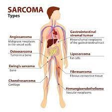 Sarkom – Symptome, Arten, Ursachen und Behandlungen