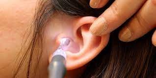 Swimmer's Ear - Symptoms and Causes